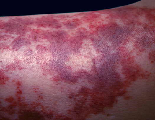 Blood Diseases and Disorders – Learn HCIS – LVN and MA Certification